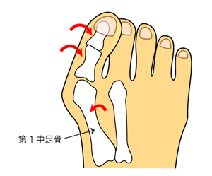 外反母趾の足の関節.png