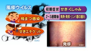 風疹ウイルスと症状.jpg